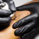 La radioterapia guiada por superficie permite evitar los tatuajes permanentes en pacientes de cáncer